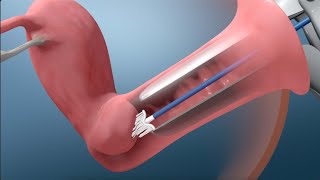 شاهد كيف يتم اخذ مسحة عنق الرحم_ Cervecal screening (pap smear test)