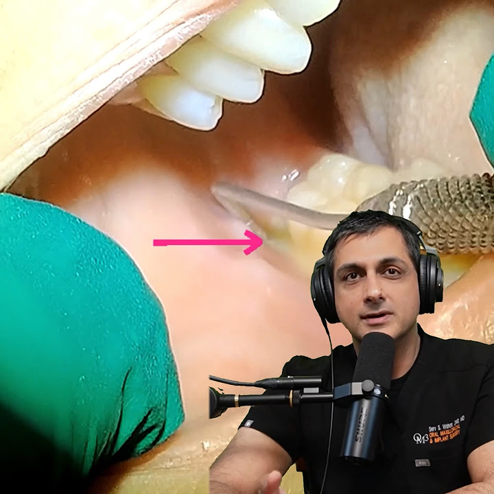 subperiosteal-abscess-after-wisdom-tooth-extraction-youtube