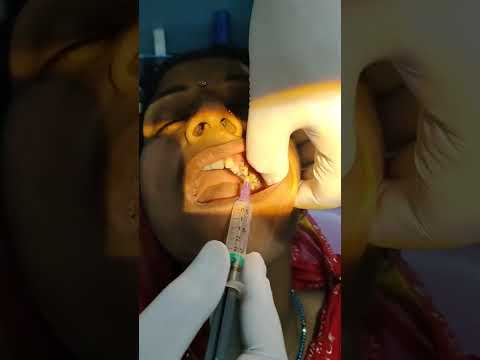 ቪዲዮ: Infraorbital ትርጉም በእንግሊዝኛ?