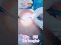 iPlus™️ FUE Hair Transplant - Planting in hair transplant @ Klinik Dr. Inder