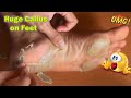 Callus Removal From Feet - 足からのカルス除去＃63