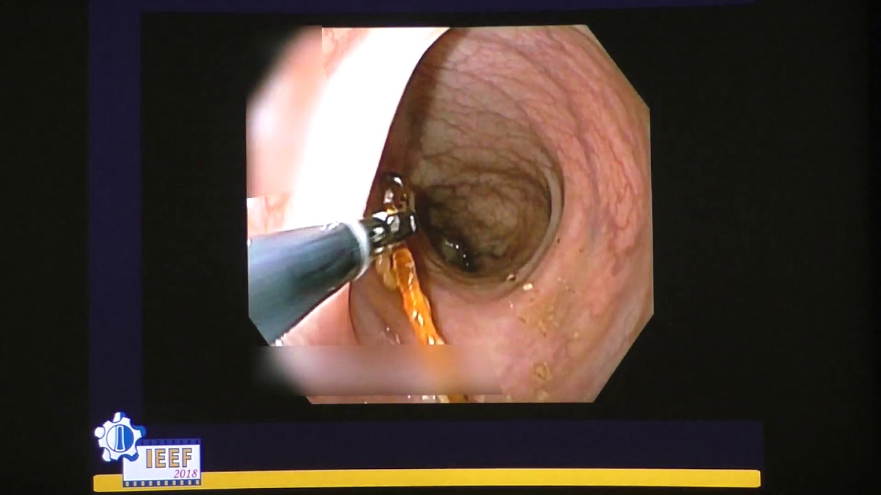 29КС Залесова ВГ Инородные тела прямой кишки
