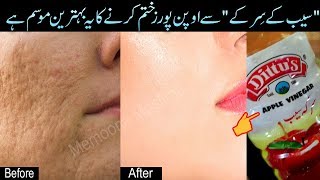 Fill Large Open Pores 100% with Apple Cider Vinegar Homemade Toner - Beauty Tips Urdu Hindi