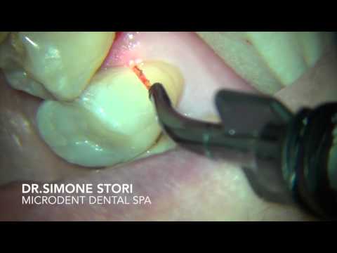Video: Trattamento Parodontale: Costo, Laser, Fasi, Opzioni E Altro