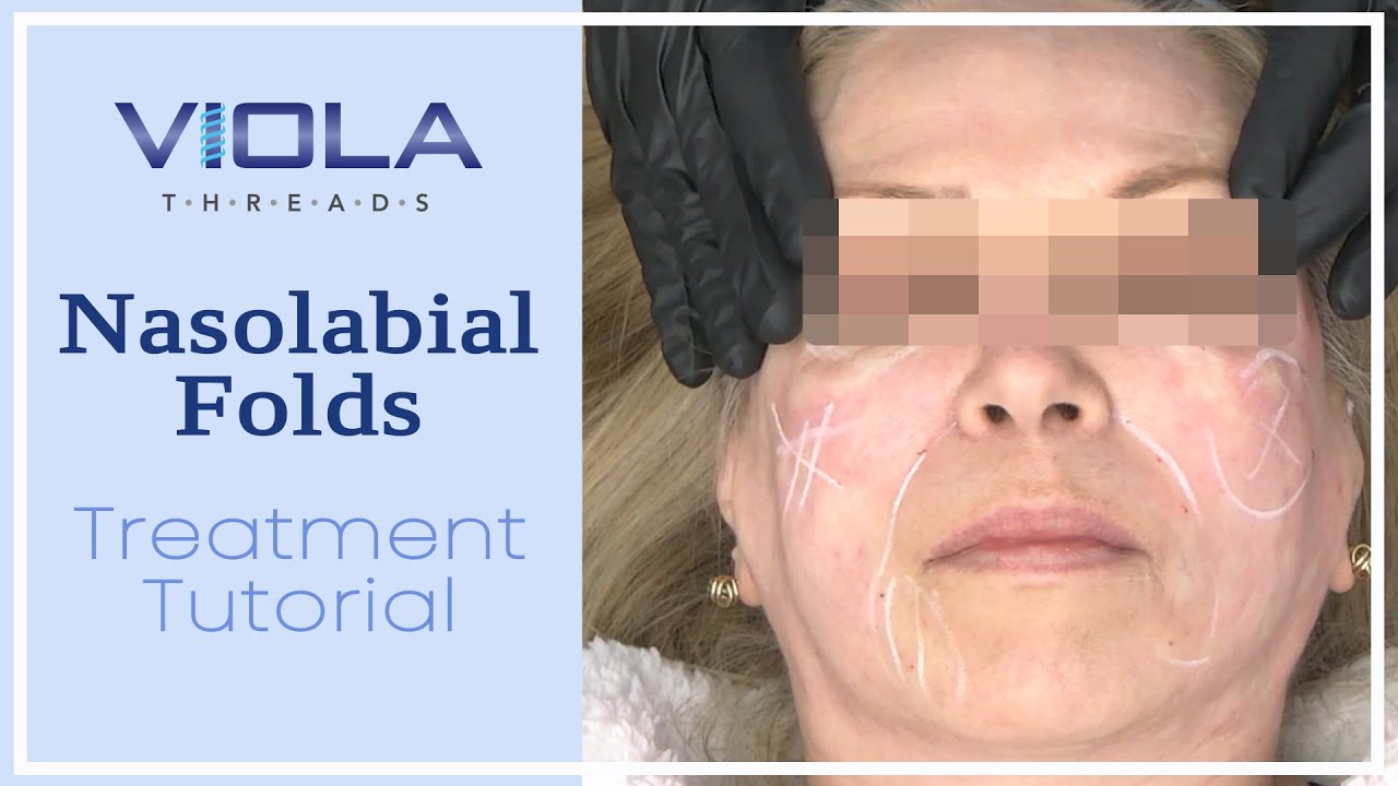 Viola Threads Nasolabial Folds Treatment Tutorial YouTube