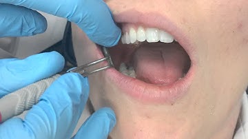 Mirror Retraction Techniques