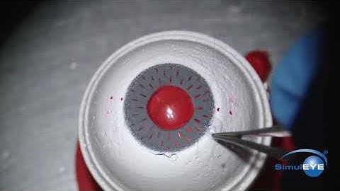 Iris fixation of IOL - McCannel Technique