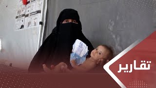 الضالع.. سوء التغذية يجتاح الأسر النازحة وتحذيرات ‏من توسعه