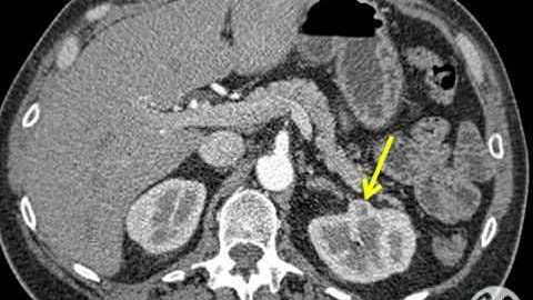 Robotic Partial Nephrectomy - Step 1: Patient Information and Operative Setup