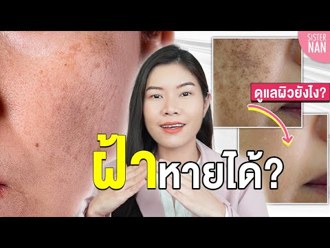 Check! What type of melasma is it? How to treat melasma. Permanent melasma. Shallow melasma. Deep...