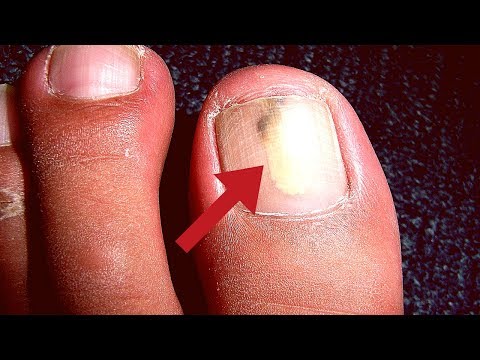 Video: 3 Möglichkeiten, Nagelpilz loszuwerden