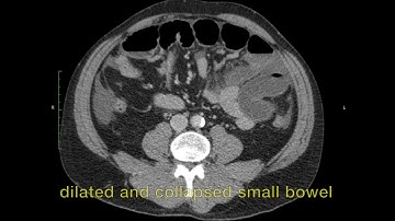 Closed loop two stenoses