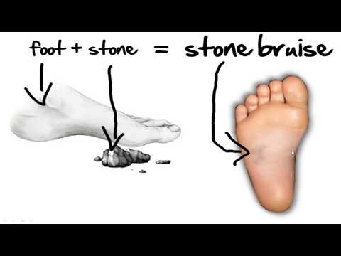 Video: Co Je Stone Bruise?