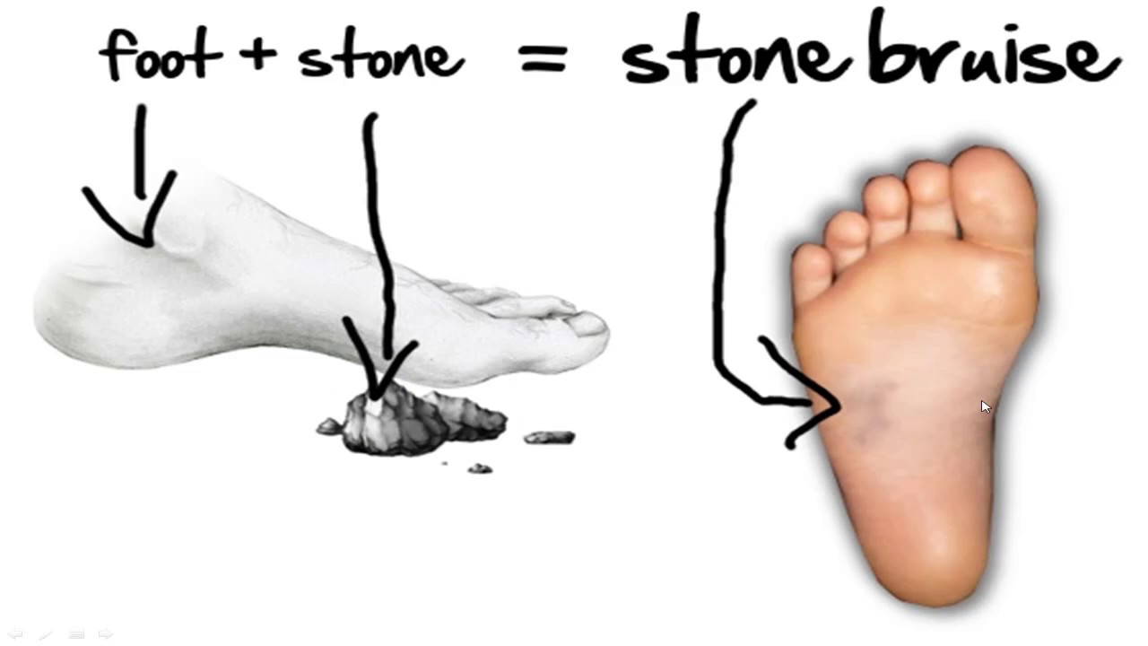 Stone Bruise Foot Pain *HOME Treatment 