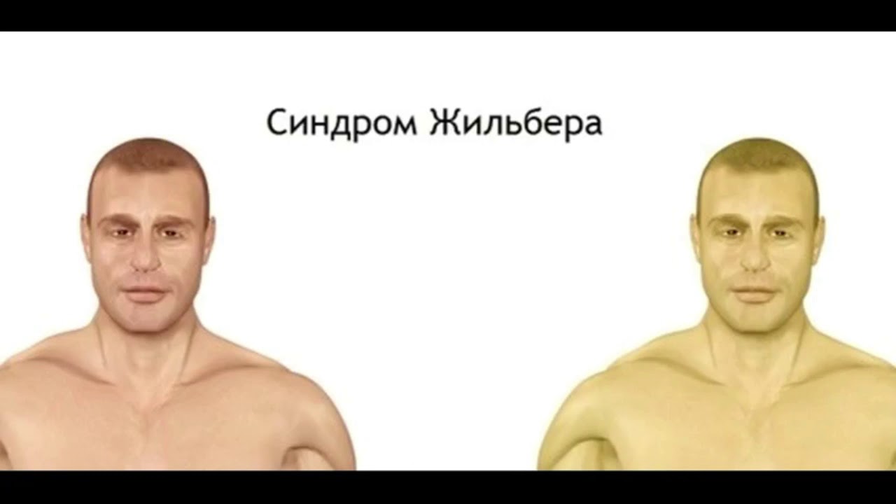 синдром жильбера клинические проявления. синдром жильбера клинические симптомы. синдром жильбера клинические симптомы. синдром жильбера что. болезнь жильбера симптомы.