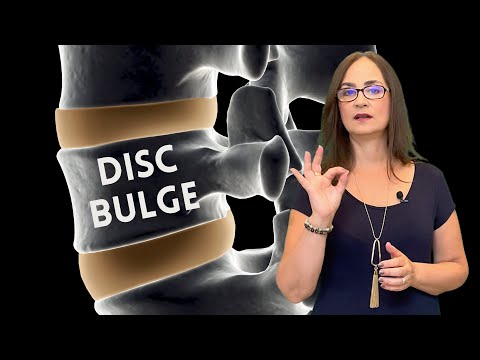 Lumbar bulging disc. Is it a serious disease? Does it progress to herniation?