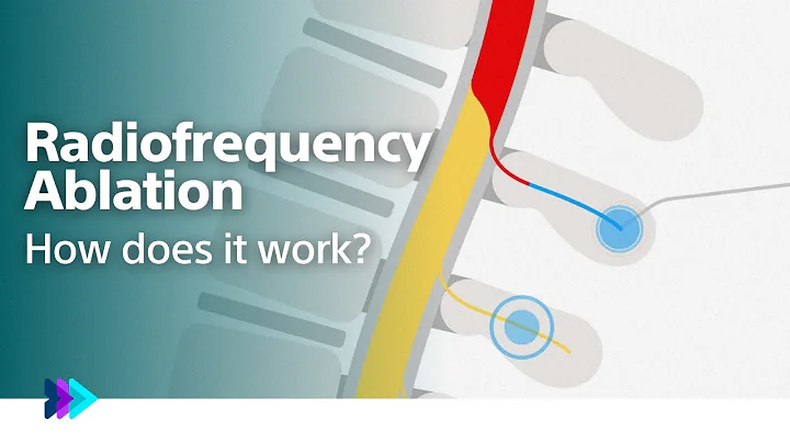 How Radiofrequency Ablation (RFA) procedure works