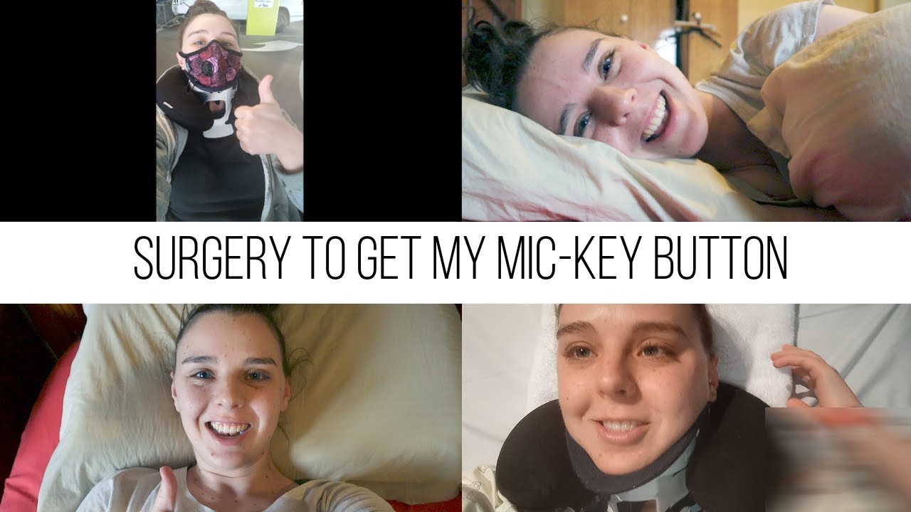 SURGERY TO GET MY MIC-KEY BUTTON! low profile feeding tube.  ( Aug 2021)