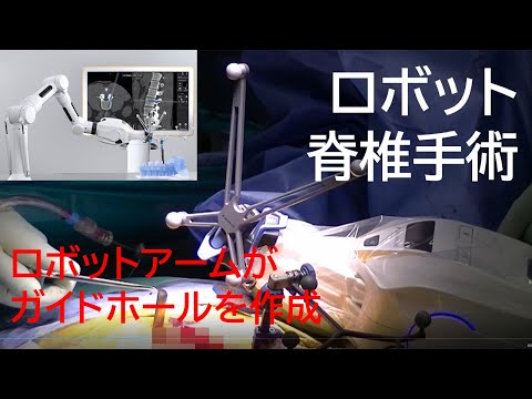 【ロボット脊椎手術】Robot armが正確な位置にガイドホールを作成