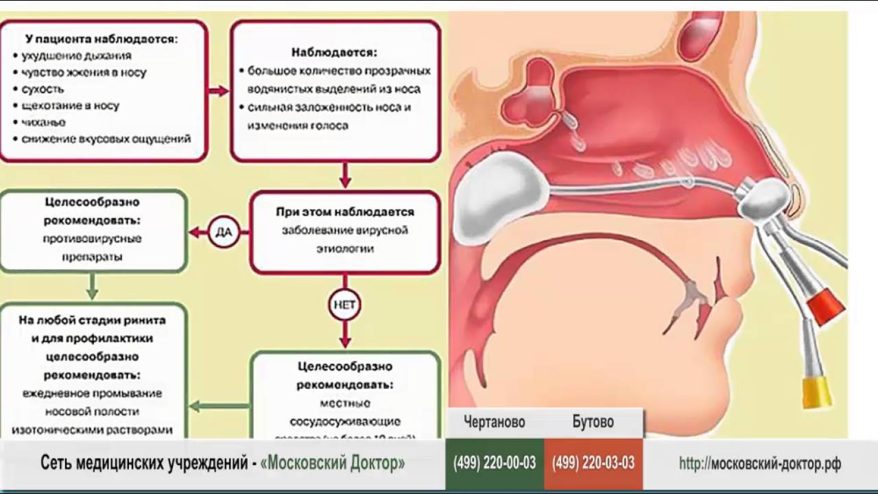 Почему постоянный насморк