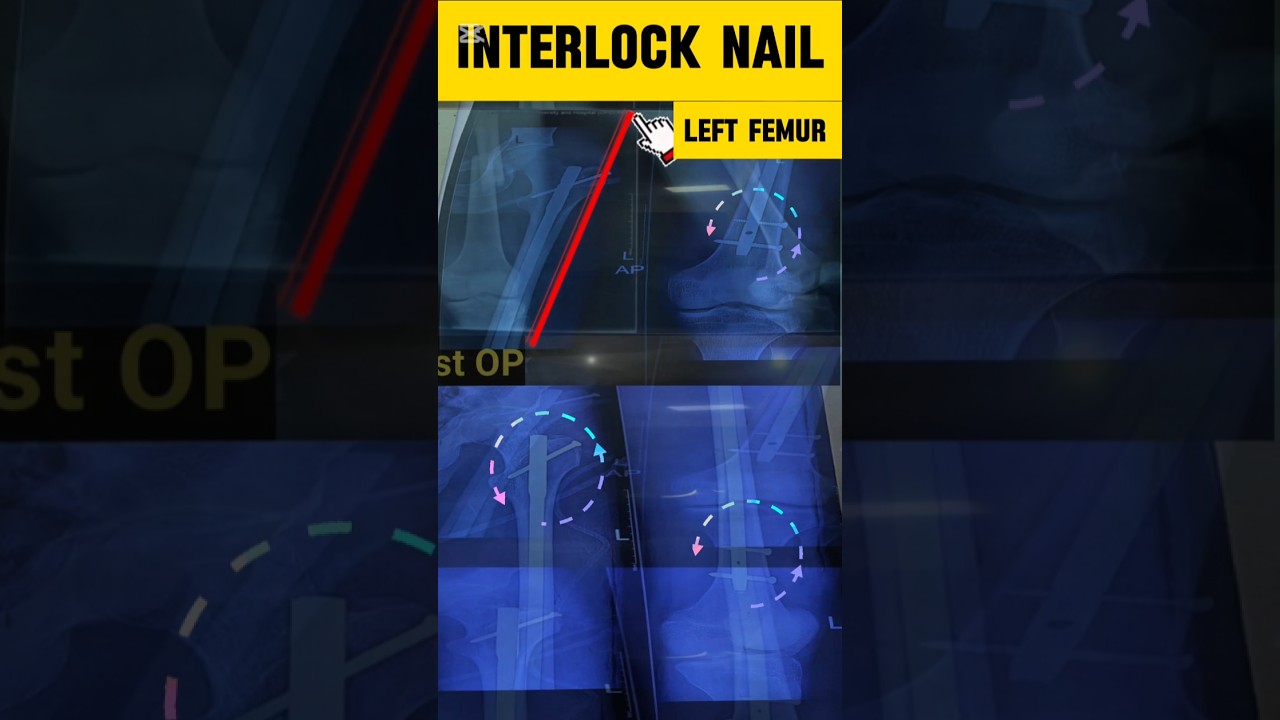 Fracture Left Shaft of Femur_ Treated with Interlock Nail !! 😳