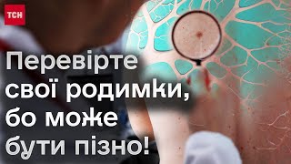 ⚡ Перевірте свої родимки! Може бути пізно! Невчасно виявлений рак шкіри - навіть смерть!