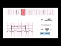 Determine HR from a Regular-Rhythm EKG | 1500- & 300-methods