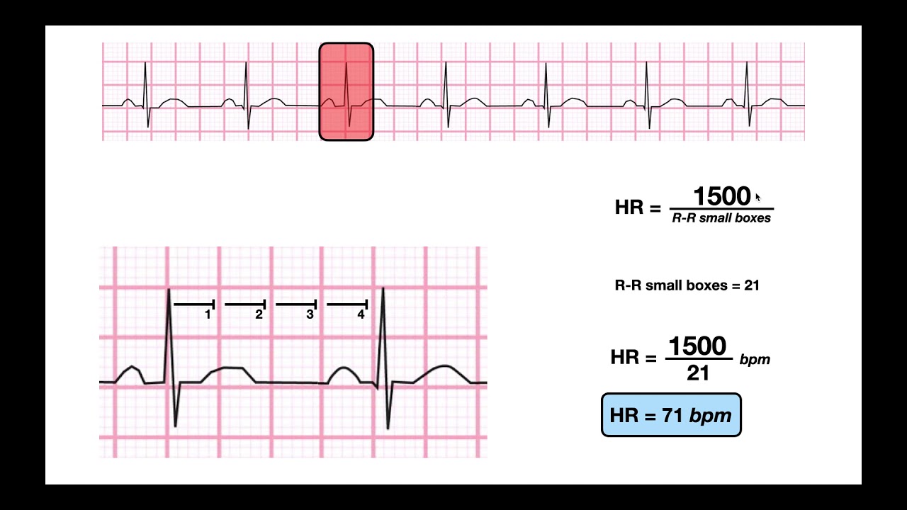 Determine Hr From A Regular Rhythm Ekg 1500 300 Methods Youtube