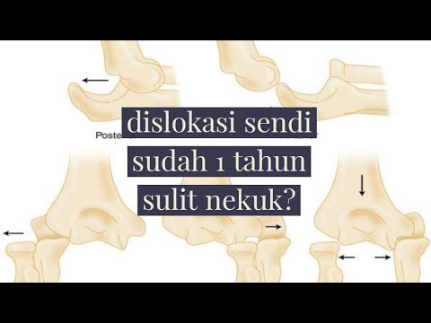 dislokasi sendi , sudah 1 tahun, sulit nekuk