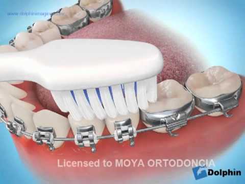 como quitar las encias inflamadas con brackets
