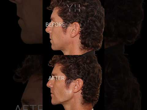 BEFORE AND AFTER JAWLINE FILLERS   #fillers #beforeandafter Book your appointment at:(212)688-5955