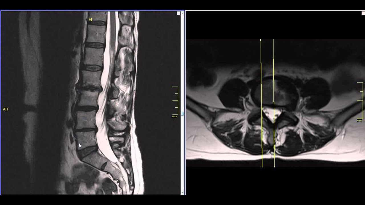 MRI Of Bulging Disc Lower Lumbar