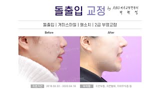 [해운대교정치과 좌동 뉴욕스마일치과] 돌출입교정(돌출입/거미스마일/왜소치/2급부정교합) B&amp;A :: 해운대좌동치과, 해운대우동치과, 해운대중동치과, 기장치과