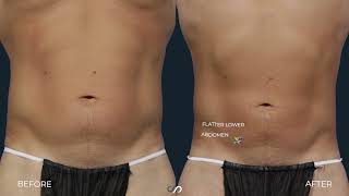 How Surgery Improved His Abs Los Angeles Dr. David Stoker