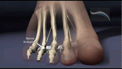 Do You Suffer From Morton