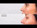 Plasma Fibroblast - Prive Academy - Nose Contouring Technique