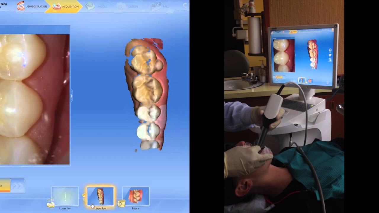 New CEREC 4.3 Software - YouTube