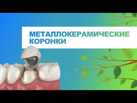 🦷 Металлокерамические коронки