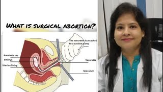 What is Surgical abortion or D&C?