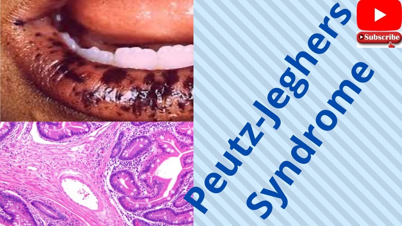 Peutz Jeghers Syndrome-Are you mindful of the key features? Watch now-usmle, neetpg, plab, fmge
