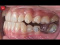 Class iii tx with aligners featuring prealigner therapychris chang orthocc649
