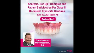 Analysis, Set Up Principles and Patient Satisfaction For Class III Bi Lateral Crossbite Dentures