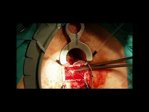 Ligation of Intersphincteric Fistula Tract (LIFT) procedure for the treatment of fistula-in-ano