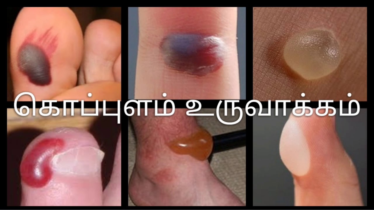 blister-explanation-in-tamil-youtube