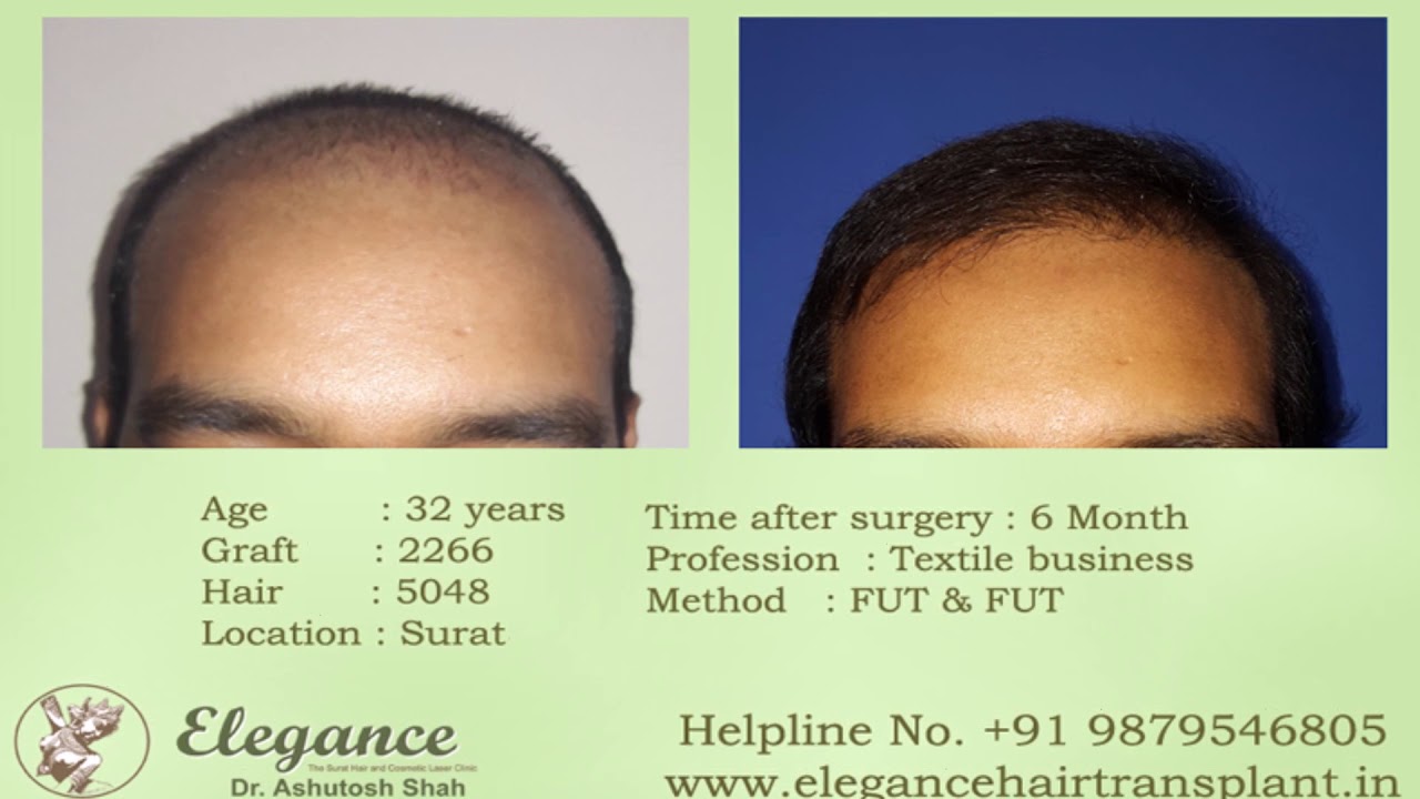 Combination hair transplant before and after result, Elegance clinic