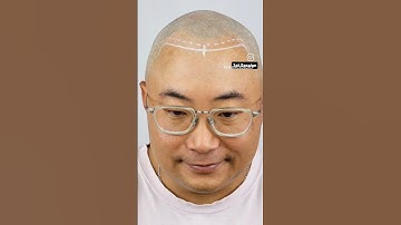 fix your hairline with scalp micropigmentation #scalpmicropigmentation #hairloss #hairline #bald