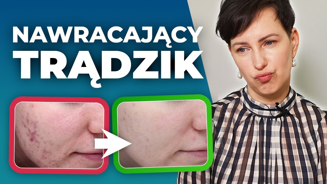 Jak wygrać z uciążliwym trądzikiem?