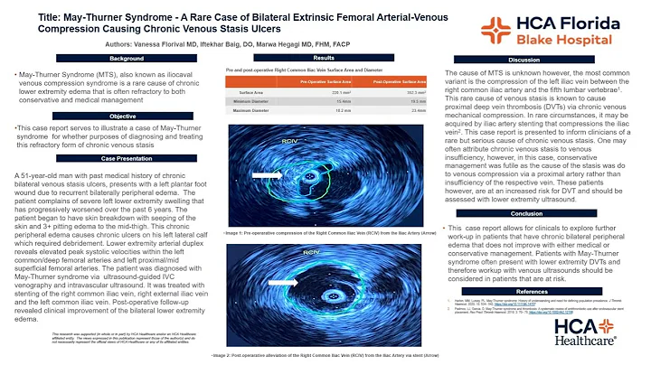 May-Thurner Syndrome Poster Vanessa Florival Submi...