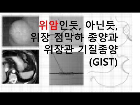 [#외과의사] 위암인듯, 아닌듯 한 병...위장의 점막하 종양괴 위장관 #기질종양..#기스트 #GIST