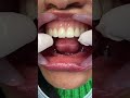 Capture de la vidéo Acrylic Dental Prosthesis Vs. On Implants #Viral #Dentist #Mrdent #Smile #Smiledentist